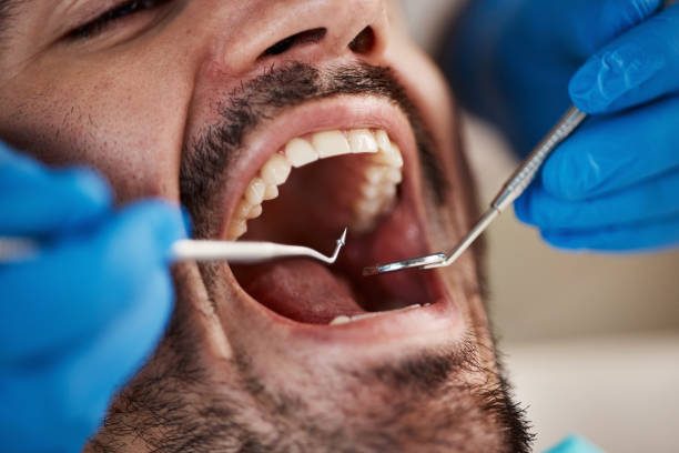 Best Emergency Dentist for Knocked-Out Tooth in Denver, NC