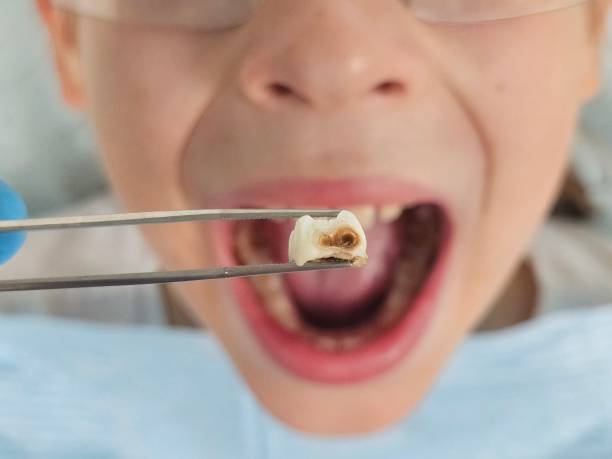 Best Emergency Dentist for Lost Fillings or Crowns in Denver, NC